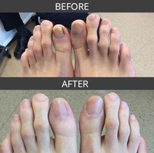 Customer photo review of German ToenailPlus™ Anti Paronychia Relief Oil