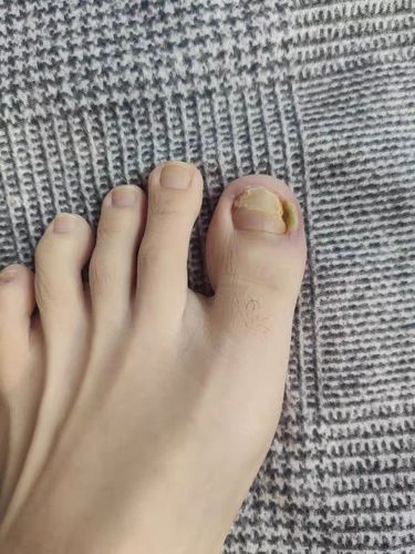 Customer photo review of German ToenailPlus™ Anti Paronychia Relief Oil