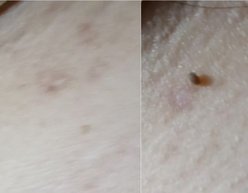 Customer photo review of Skin Deluxe™ Wart Removal Ointment