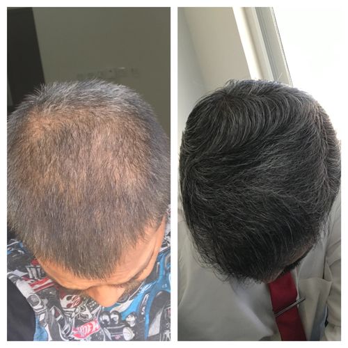 Customer photo review of HårExpert™ Naturlig Hårväxtolja