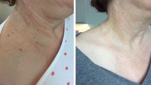 Customer photo review of Skin Deluxe™ Wart Removal Ointment