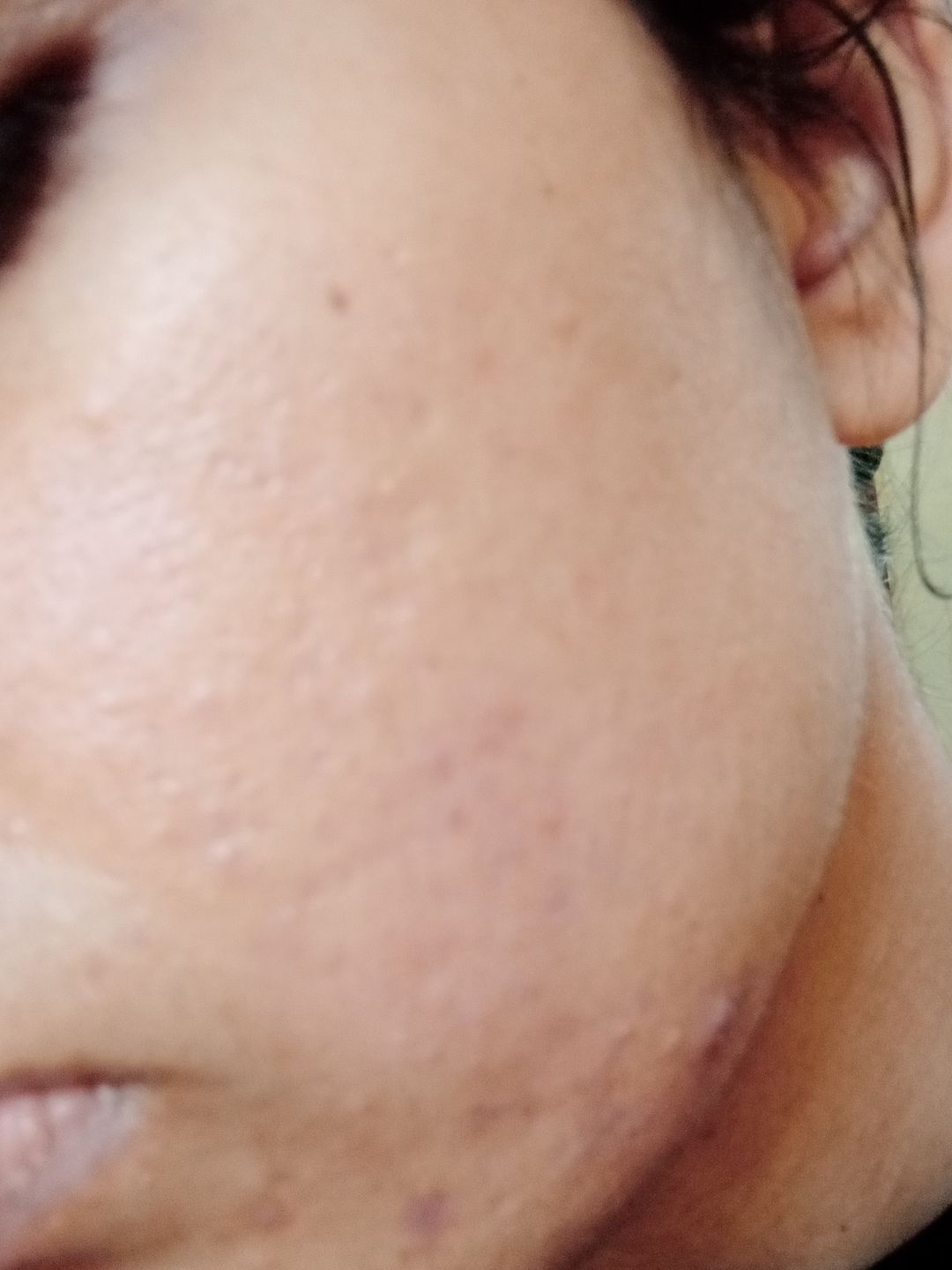 Customer photo review of Kojic Serum – Time to fall in love with yourself, prevents hyperpigmentation, fades dark spots, treats melasma, minimizes discoloration – 100% pure organic