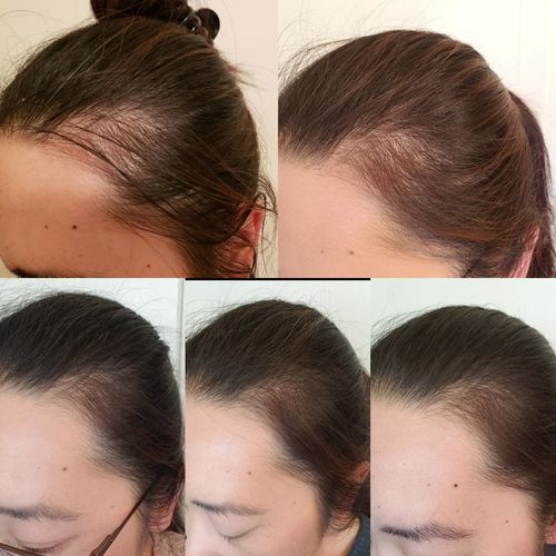 Customer photo review of HårExpert™ Naturlig Hårväxtolja