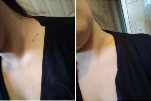Customer photo review of Skin Deluxe™ Wart Removal Ointment
