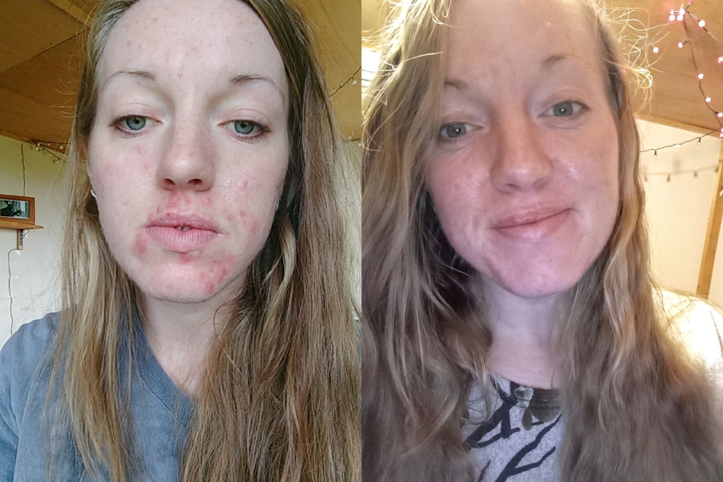 Customer photo review of Antiac Daily Face Wash