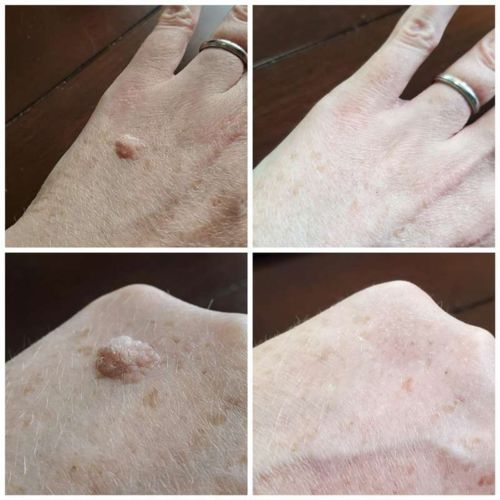 Customer photo review of Skin Deluxe™ Wart Removal Ointment