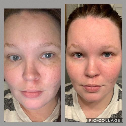 Customer photo review of Beautology™ Anti-Rynkor Ögonmask