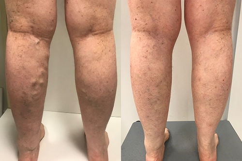 Customer photo review of VeinsAway™ Åderbråck Behandlingskräm
