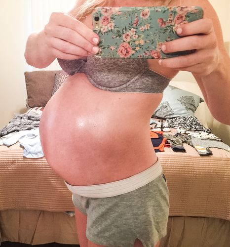 Customer photo review of StretchClear™ Bristningar Borttagningskräm