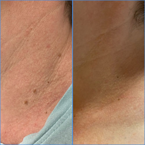 Customer photo review of TagOff™ Det Säkraste Sättet Att Ta Bort Hudflikar Hemma