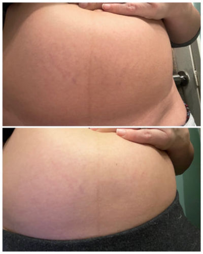 Customer photo review of StretchClear™ Bristningar Borttagningskräm