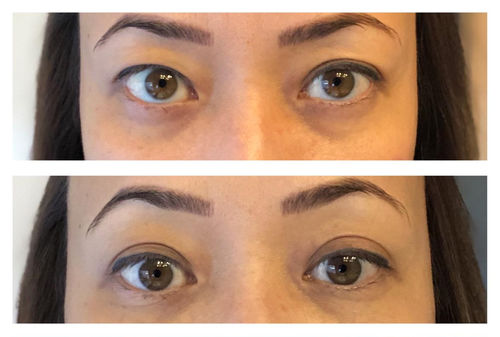 Customer photo review of DubblaEyelids™ Kompletta Ögonlocksstylingset
