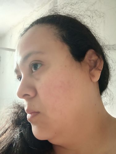 Customer photo review of Kit anti acné