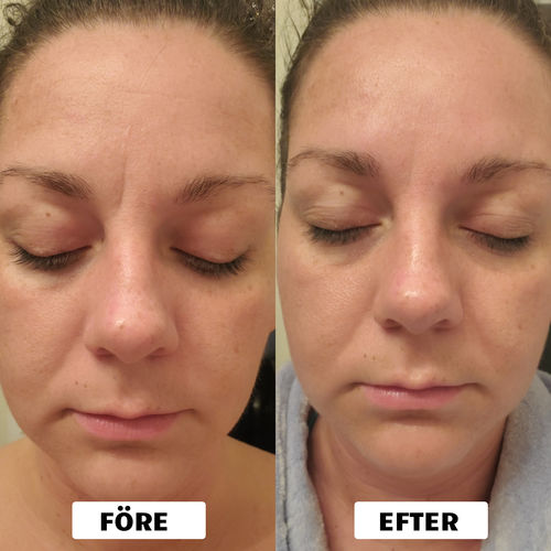 Customer photo review of InvisiTejp™ Antirynk Ansiktslyfttejp