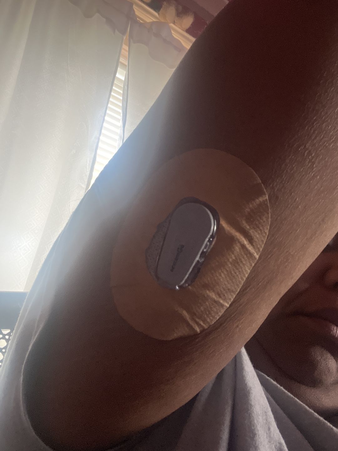 Customer photo review of Skin Grip MAX Dexcom G6 Patches