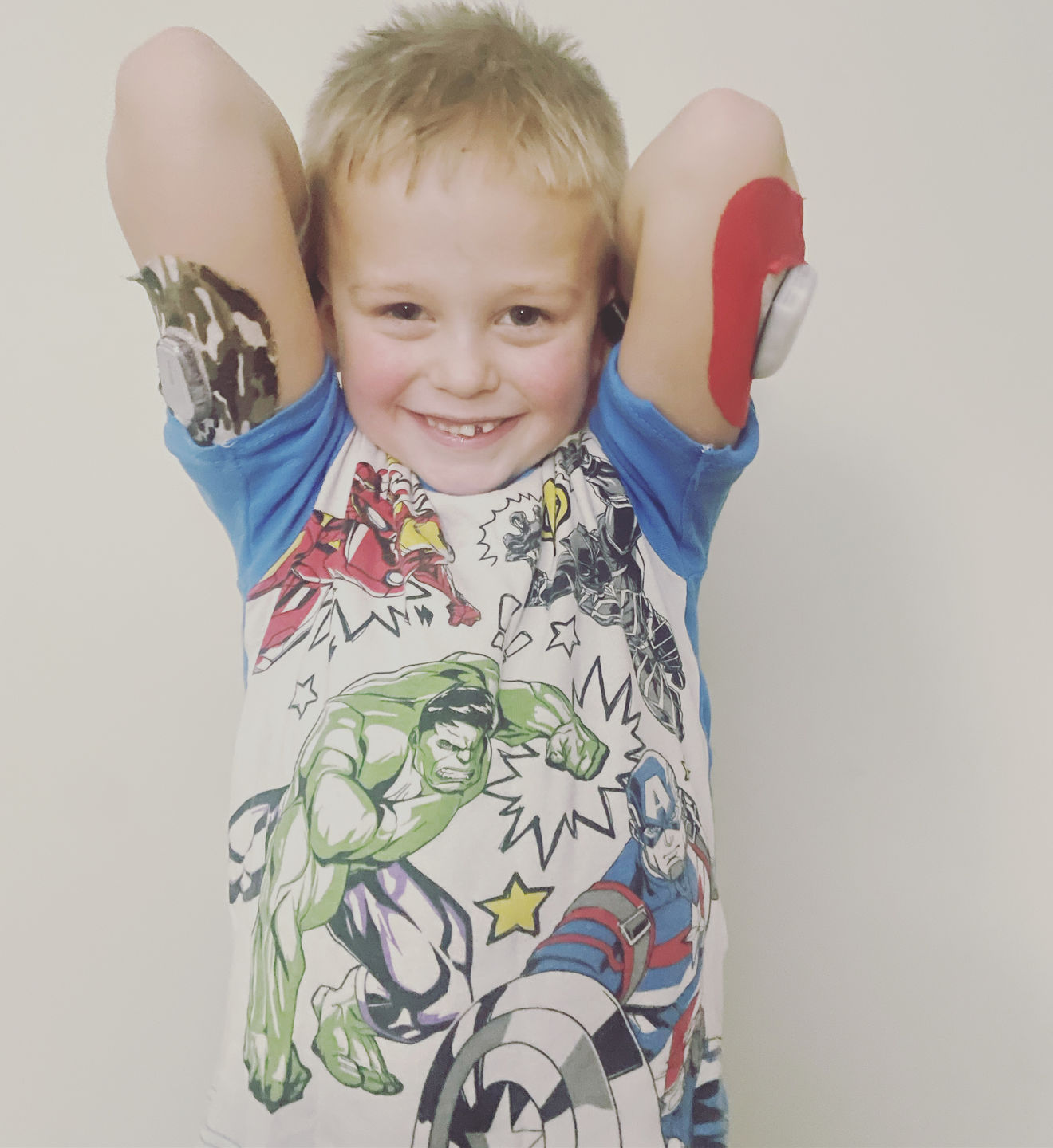 Customer photo review of Skin Grip Original - Omnipod Adhesive Patches