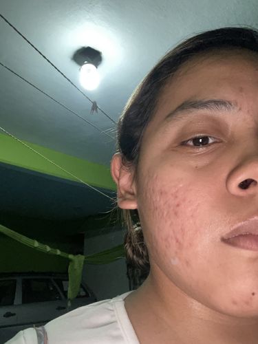 Customer photo review of Kit anti acné