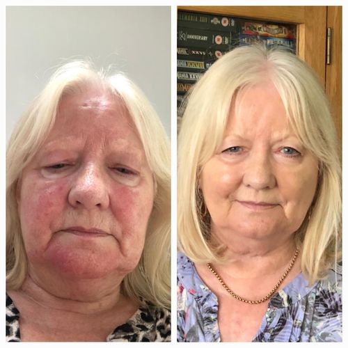 Customer photo review of Rosalique 3 in 1 Anti-Redness Miracle Formula SPF50