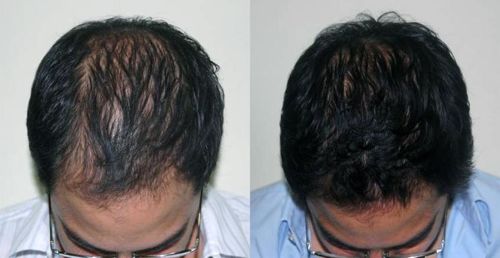 Customer photo review of Minoxidil Root Activator Serum