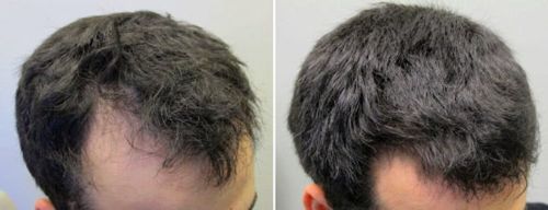 Customer photo review of Minoxidil Root Activator Serum