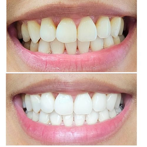 Customer photo review of Polar MD Teeth Whitening Kit