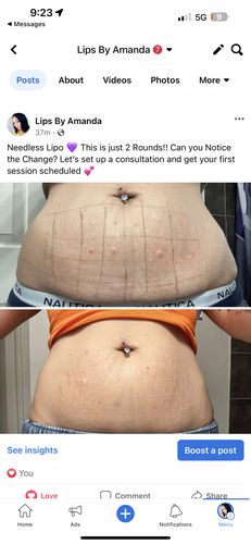 Customer photo review of MesoLipo Serum