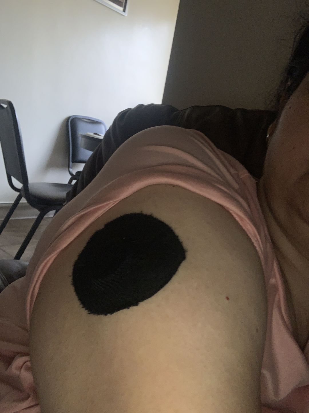 Customer photo review of Skin Grip Original - Freestyle Libre Adhesive Patches