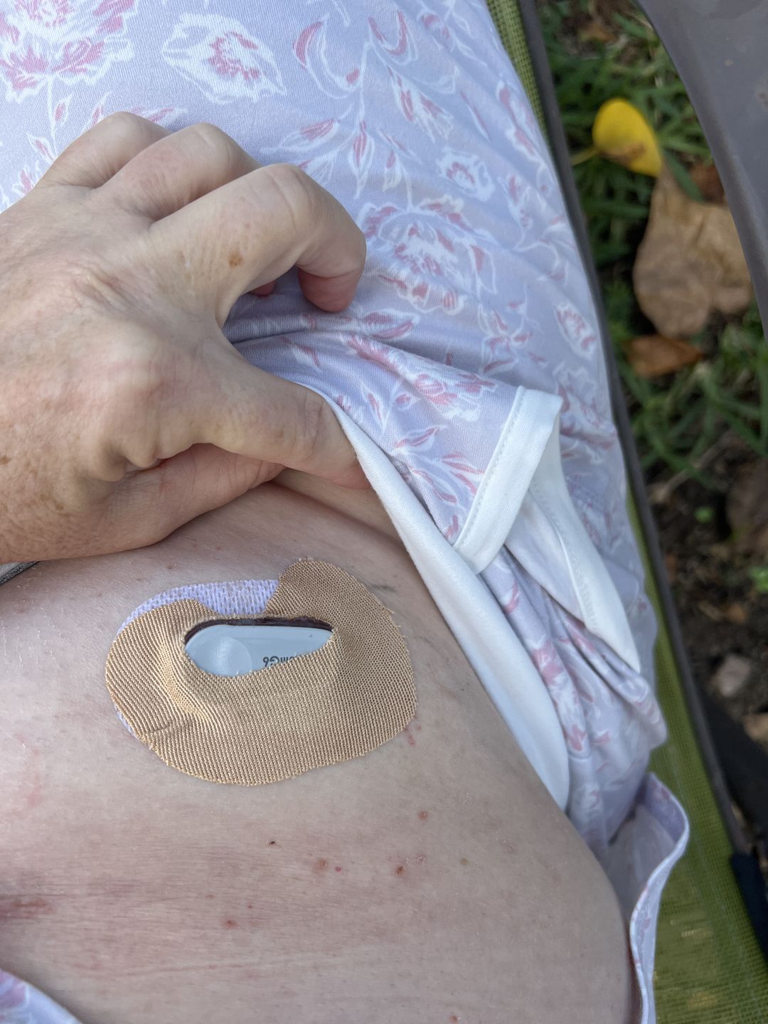 Customer photo review of Skin Grip MAX Dexcom G6 Patches