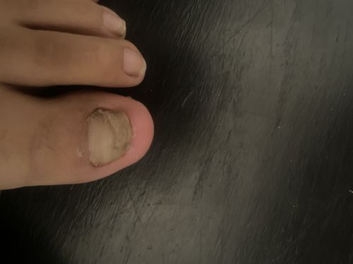 Customer photo review of Onychom - Antifungal Laser Device