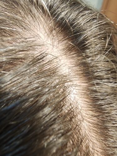 Customer photo review of שמפו טיפולי נגד קשקשים | SCALP CONTROL DANDRUFF SHAMPOO