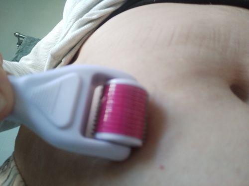 Customer photo review of Femvy Derma Roller 6-in-1 Kit