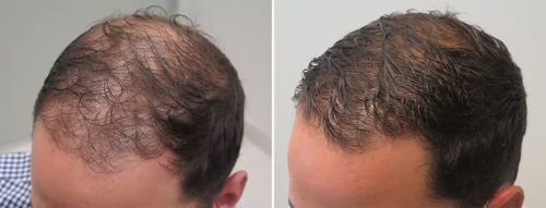 Customer photo review of Tight Hairstyle Hair Loss Survival Pack