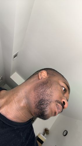 Customer photo review of 10% Tugain Foam Minoxidil Extra Strength Hair Regrowth for Men.