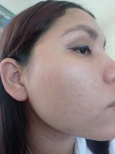 Customer photo review of Kit anti acné