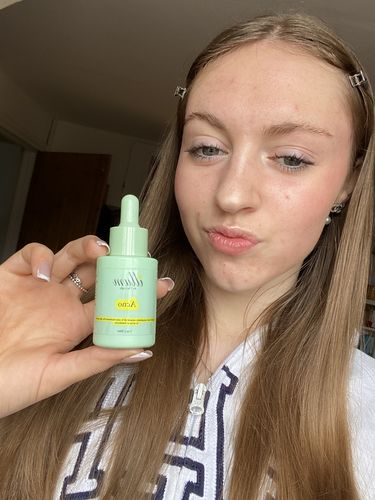 Customer photo review of illum Acno Face Oil - For Acne