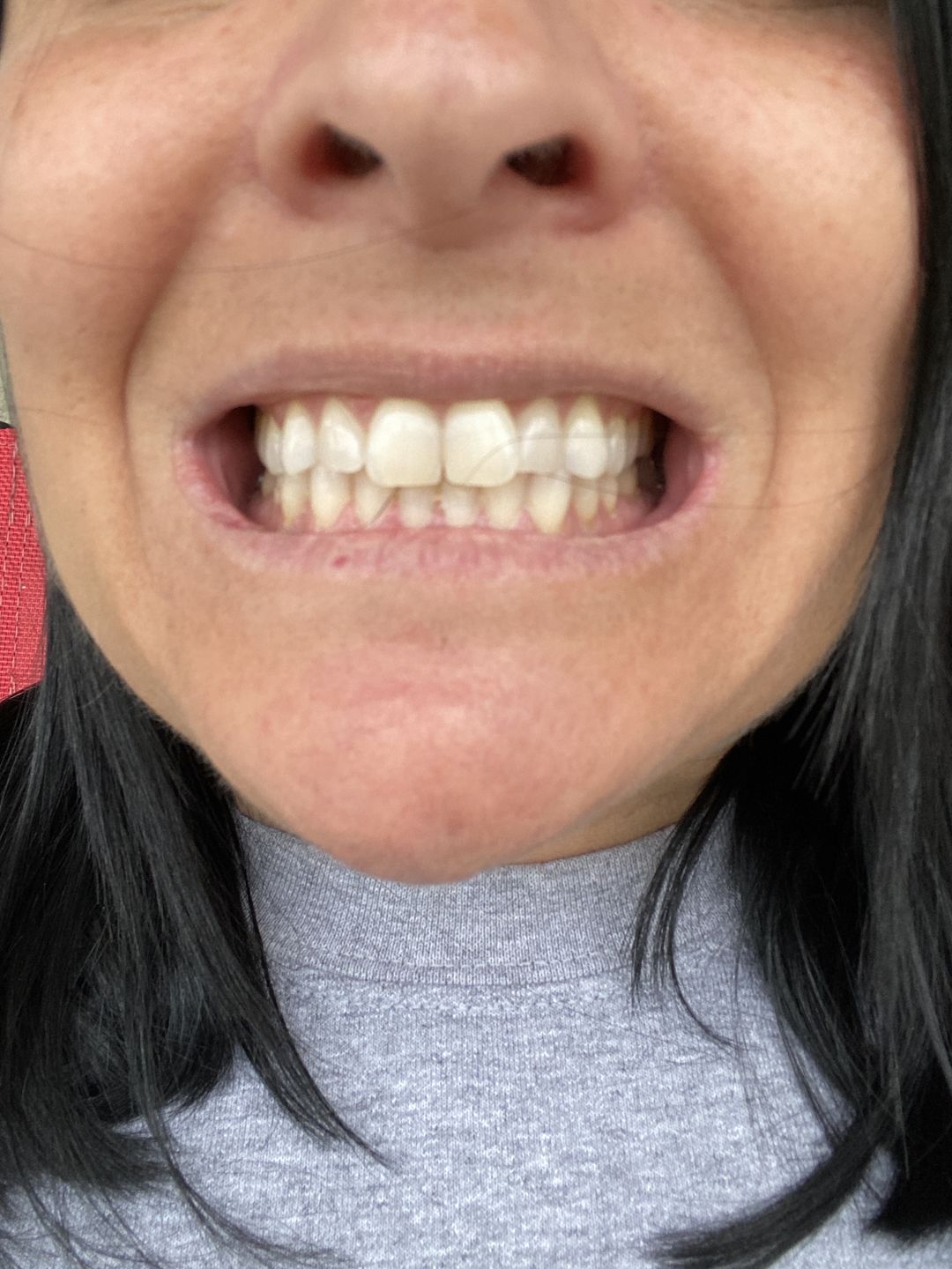 Customer photo review of Bandes Blanchissantes PAP (sans peroxyde)