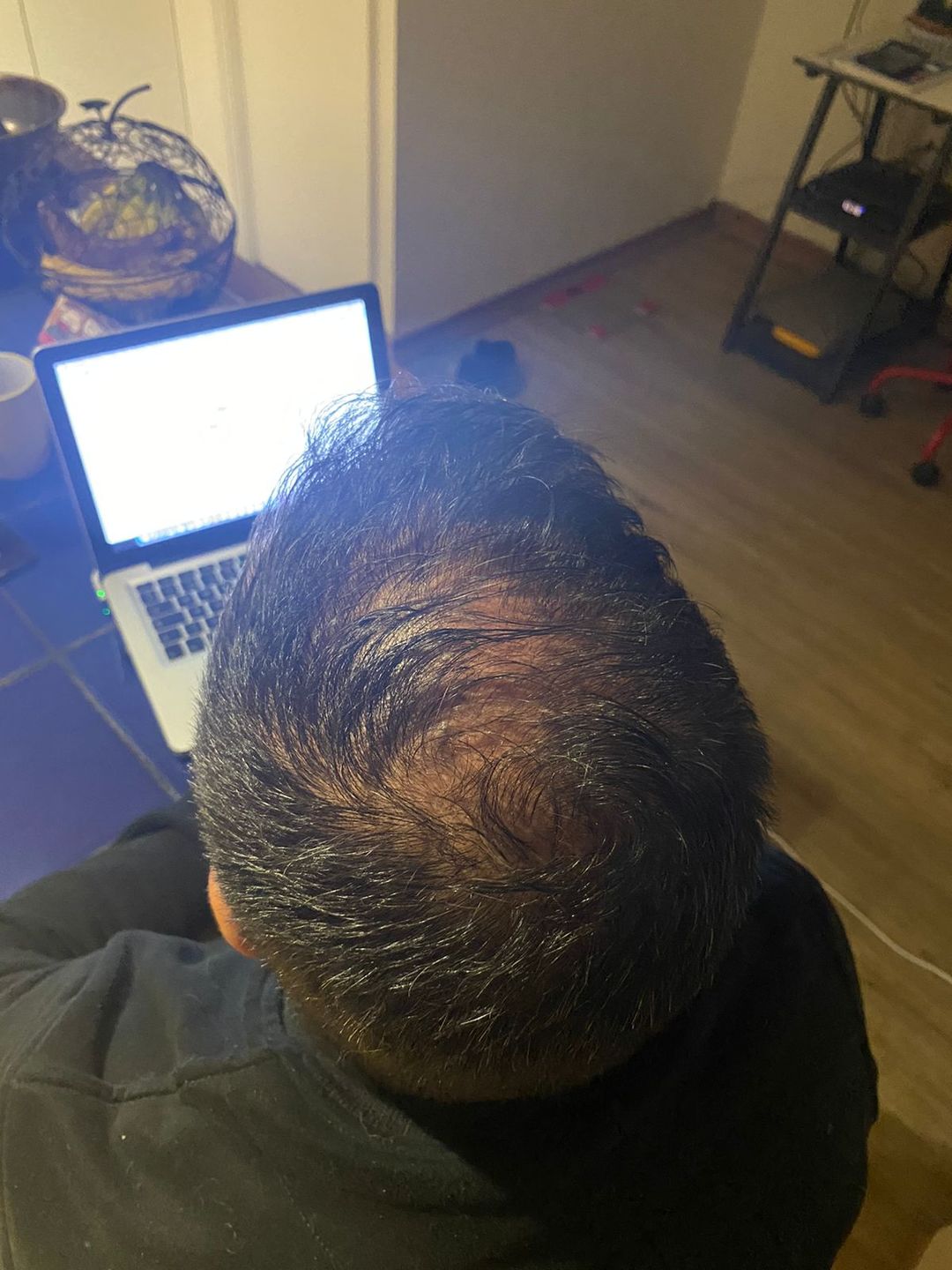 Customer photo review of Tónico anticaída + shampoo anticaída en barra