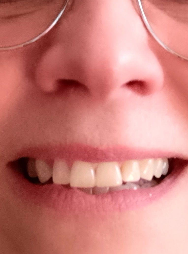 Customer photo review of Bandes Blanchissantes PAP (sans peroxyde)