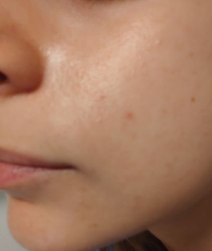 Customer photo review of ערכה טיפולית לעור פנים אדמומי | SEBO T-ZONE KIT