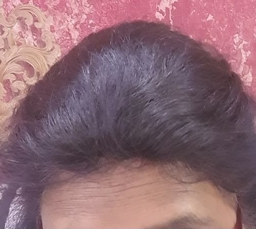 Customer photo review of INVISIBLE COVER-UP PATCH - WAVY