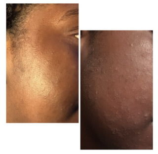 Customer photo review of Bolden Clear Skin Travel Kit