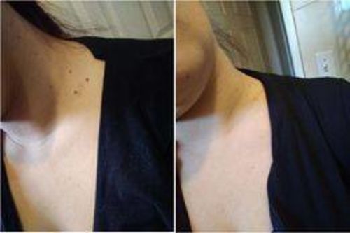 Customer photo review of CC™ Tags & Moles Remover(Mother's Day Discount 🔥 Last Day)