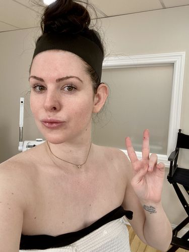 Customer photo review of ChinFix: Filler