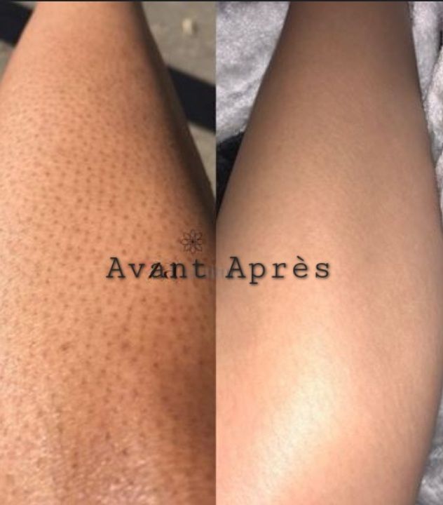 Customer photo review of Gomme Dépilatoire Gomépil™