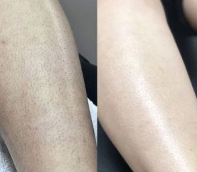 Customer photo review of Gomme Dépilatoire Gomépil™