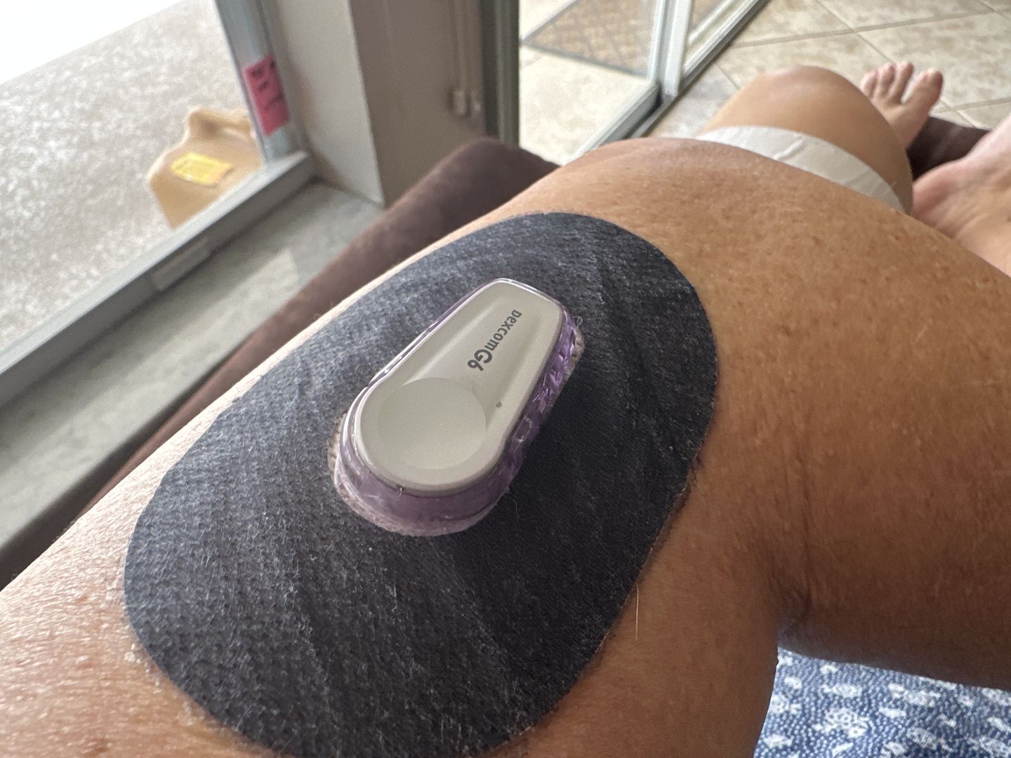 Customer photo review of Skin Grip MAX Dexcom G6 Patches
