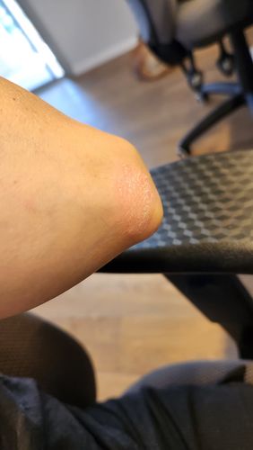 Customer photo review of ערכה טיפולית ליובש וקילופים בעור | PSO BODY & SCALP KIT