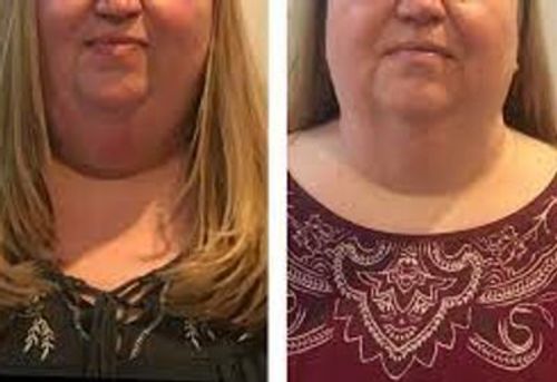 Customer photo review of Dorina EarAcupressure Magnetherapy Detoxi Earrings（Limited Time Discount 🔥 Last Day）