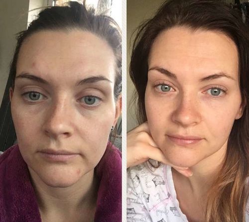 Customer photo review of Dorina EarAcupressure Magnetherapy Detoxi Earrings（Limited Time Discount 🔥 Last Day）