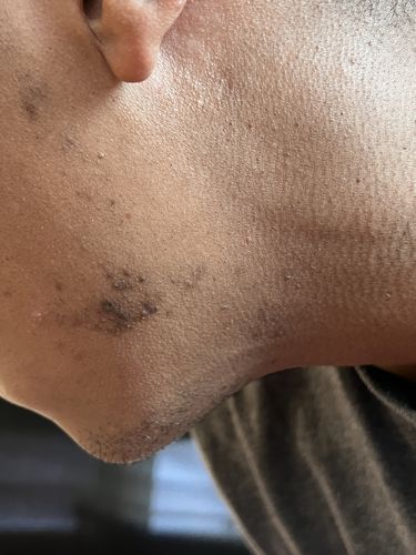 Customer photo review of SEOUL FOOD SERUM FOR DARK SPOTS & TEXTURE